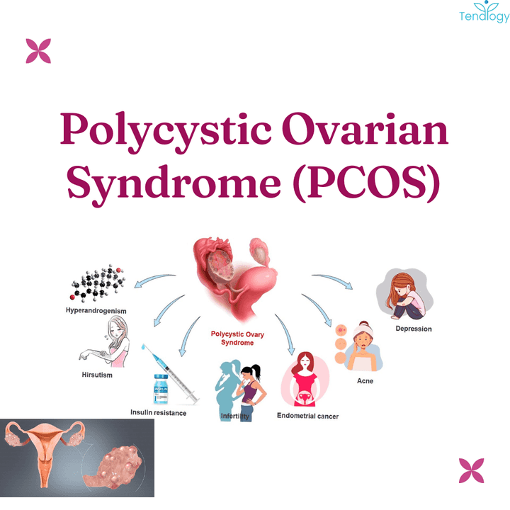 THW43- Polycystic Ovarian Syndrome; Symptoms, Diagnosis, and Management